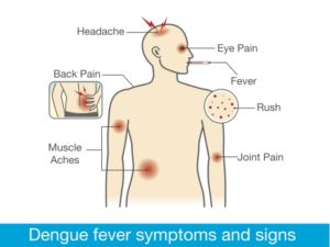 Dengue symptoms. (Shutterstock)